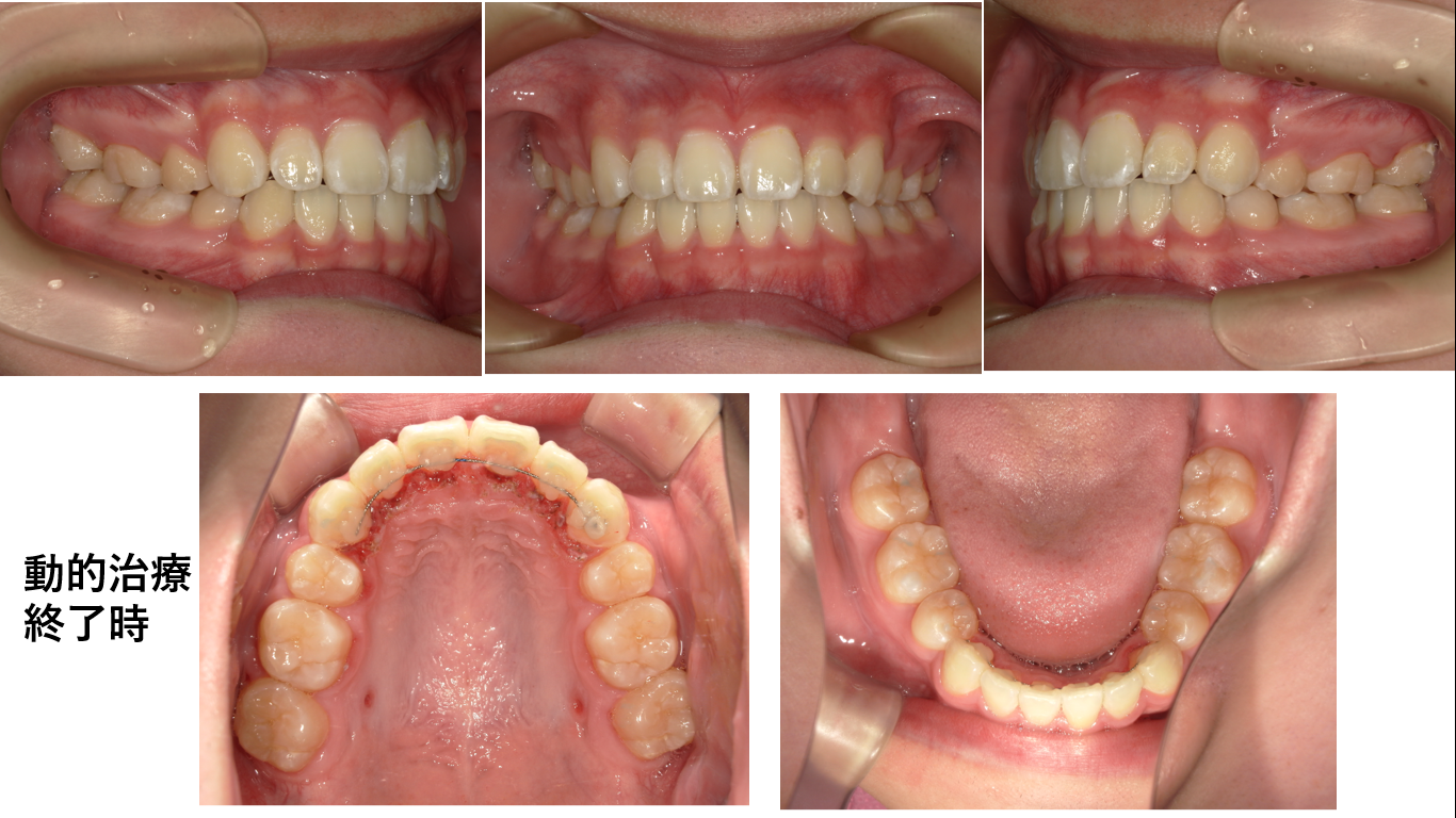 矯正症例148　AngleⅠ級上顎前突、裏側矯正、舌側矯正