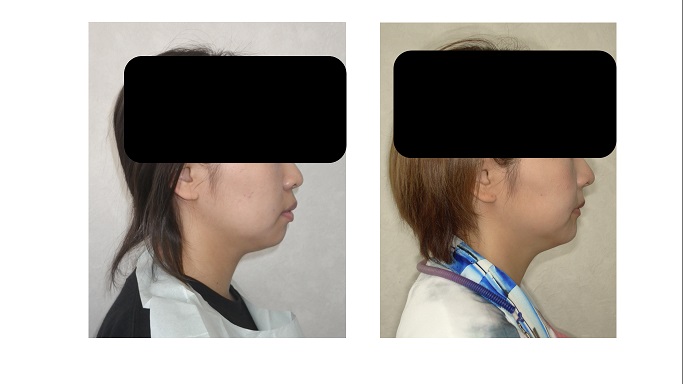 矯正症例92 AngleⅠ級歯槽性上下顎前突