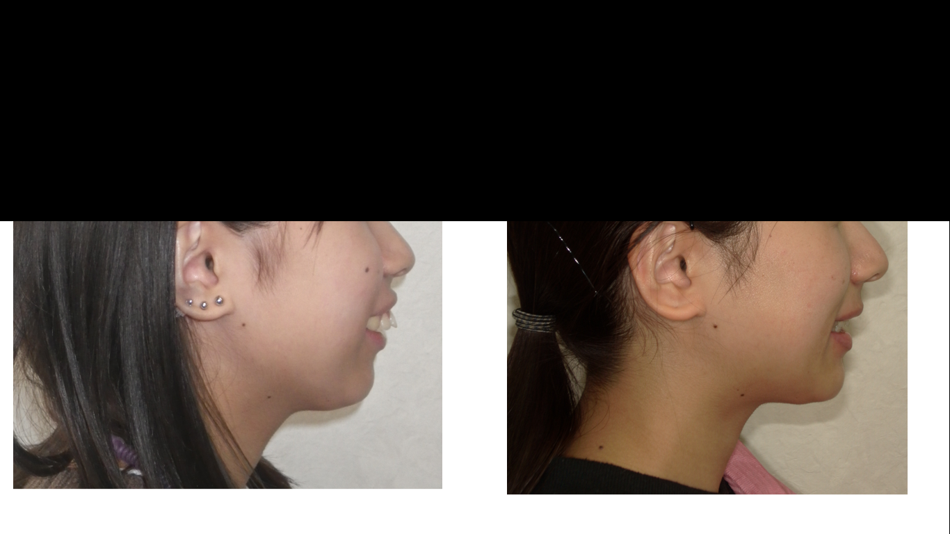 矯正症例138 AngleⅡ級1類 上顎前突