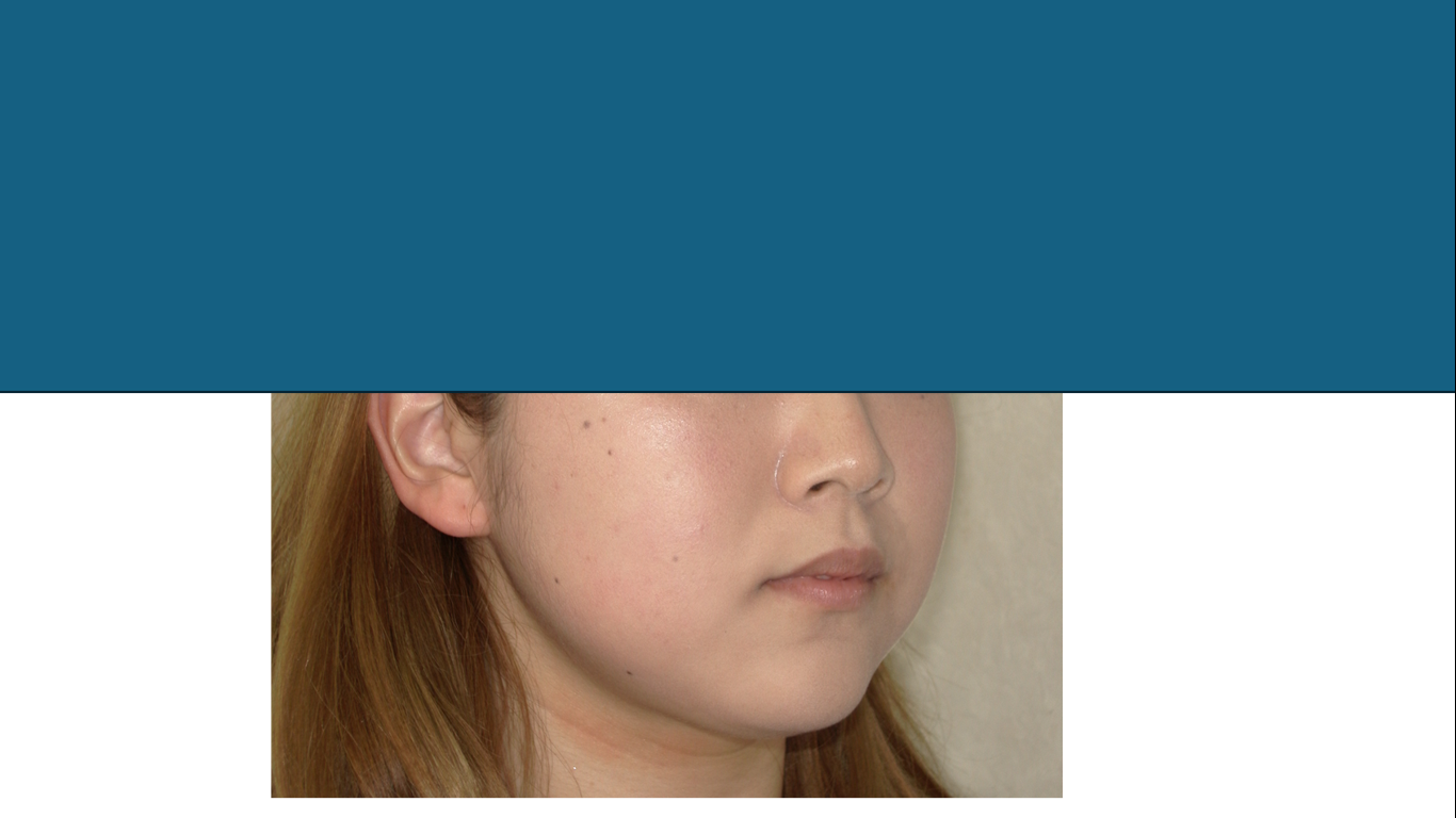 矯正症例142、AngleⅠ級、上顎前突