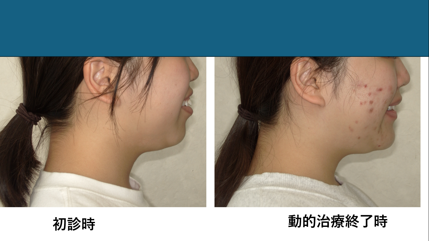 矯正症例141 AngleⅠ級 上下顎前突、ガミースマイル、口ごぼ