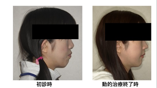 矯正症例87 上下顎前突 ハーフリンガル 裏側矯正 能代市、大館市、潟上市、北秋田市、秋田市