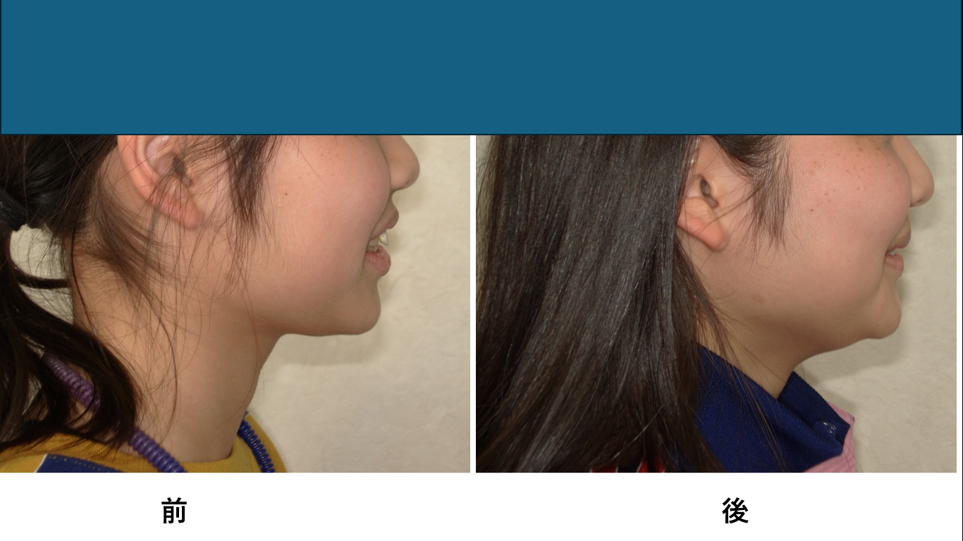 矯正症例149　AngleⅠ級上顎前突