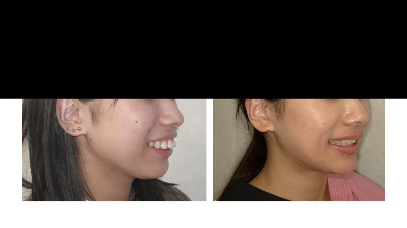 矯正症例138 AngleⅡ級1類 上顎前突