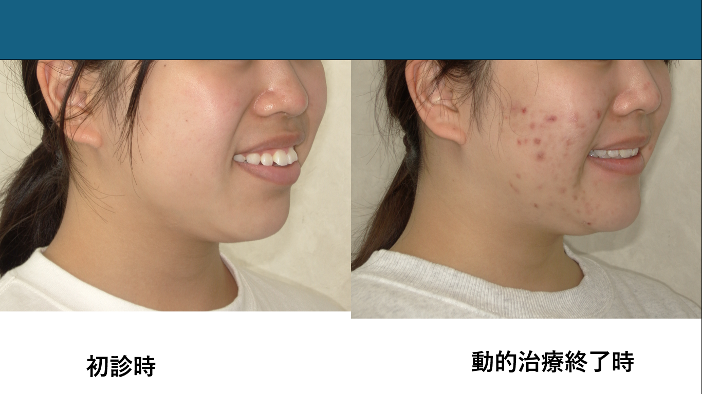 矯正症例141 AngleⅠ級 上下顎前突、ガミースマイル、口ごぼ