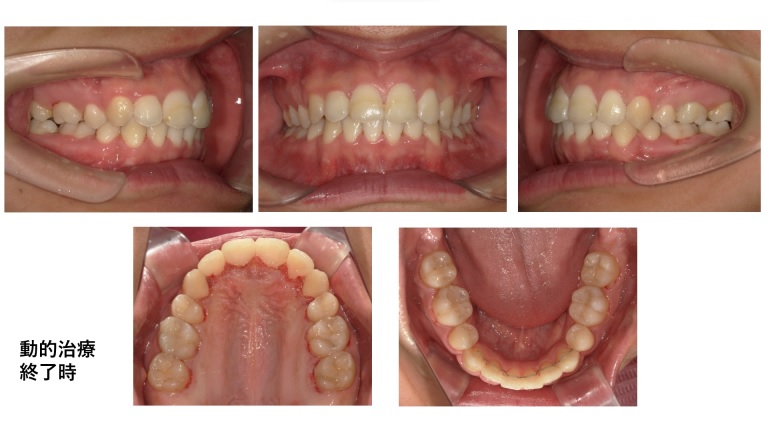 矯正症例94ハーフリンガル症例　叢生を伴うAngleⅠ級上下顎前突、裏側矯正、能代市、北秋田市、大館市