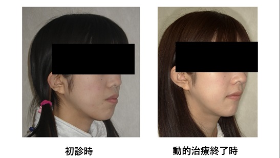 矯正症例87 上下顎前突 ハーフリンガル 裏側矯正 能代市、大館市、潟上市、北秋田市、秋田市