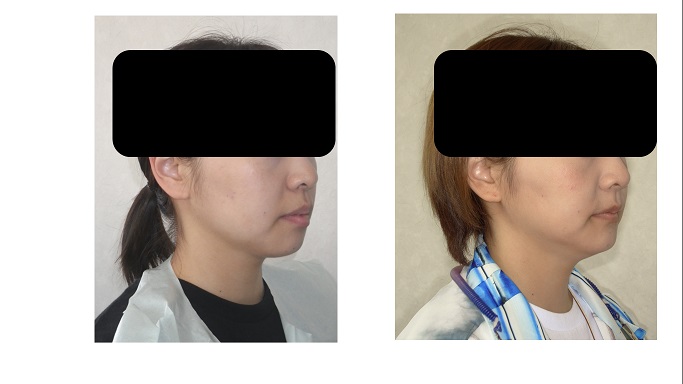 矯正症例92 AngleⅠ級歯槽性上下顎前突