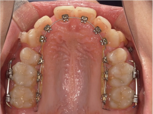矯正症例94ハーフリンガル症例　叢生を伴うAngleⅠ級上下顎前突、裏側矯正、能代市、北秋田市、大館市