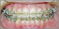 上の前歯6本が白または透明、下の前歯は金属