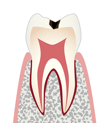 C1（エナメル質までの虫歯）