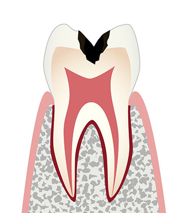 C2（象牙質に達する虫歯）
