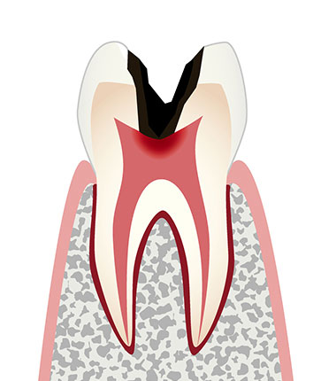 C3（神経に達する虫歯）