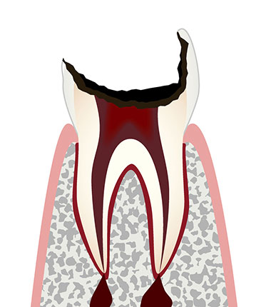 C4（歯の根に達する虫歯）