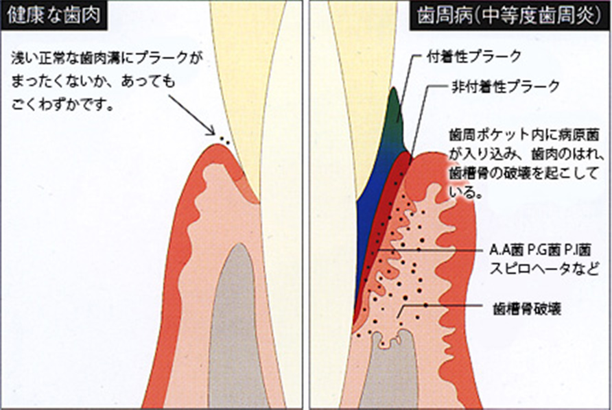 図1-2 健康な歯肉と歯周病