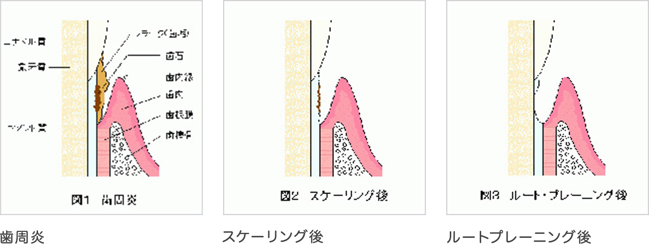 スケーリング、ルートプレーニング