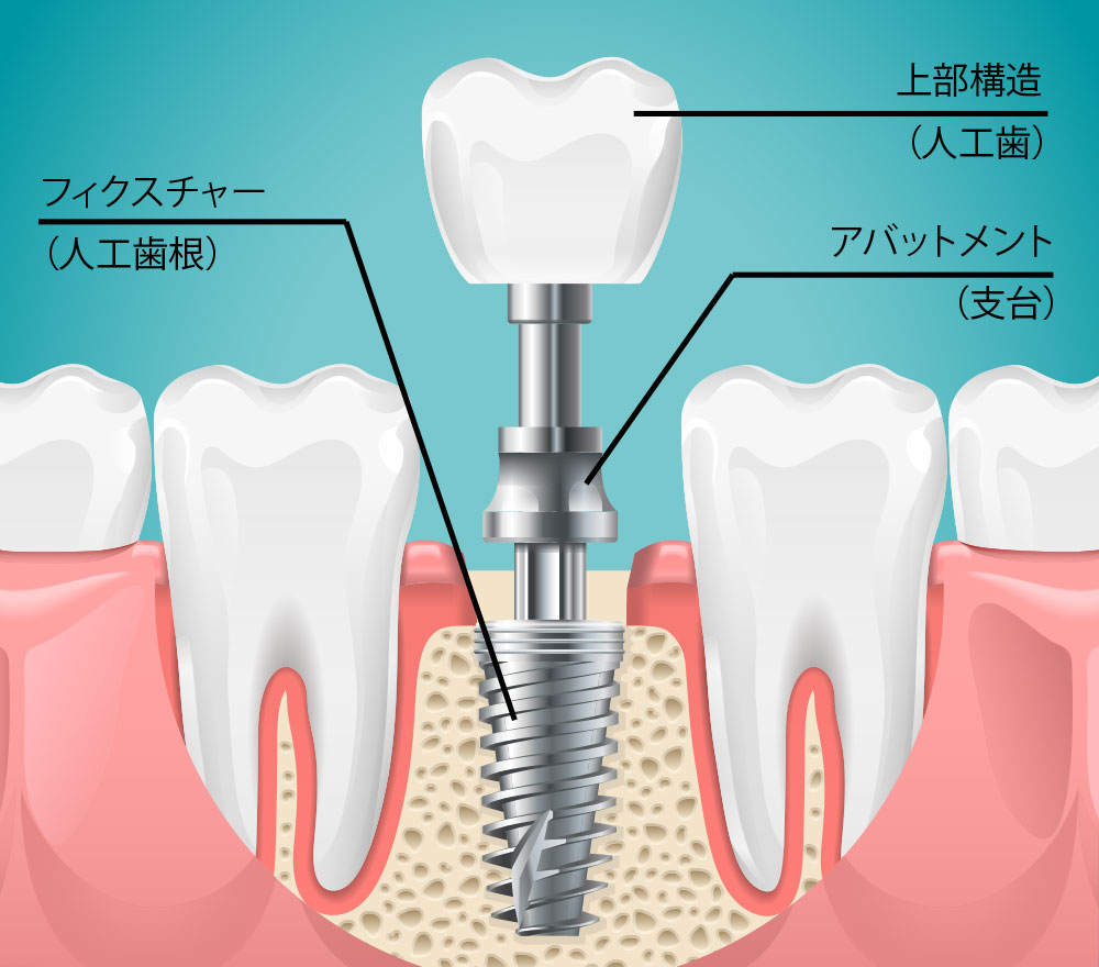 インプラント治療について